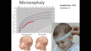 16p112 Neurological Findings [upl. by Goodman126]