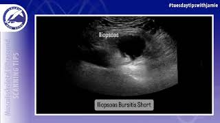 Iliopsoas Bursa Visualization on MSK Ultrasound [upl. by Ambrosine]