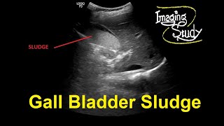 Gallbladder Sludge  Ultrasound  Case 30 [upl. by Eniluj]