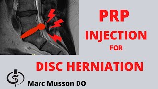 PRP Injection For Disc Herniation  Platelet Rich Plasma Epidural Injection [upl. by Wycoff]