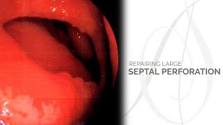 How to Repair a Septal Perforation [upl. by Maclay]