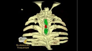 Ependymoma [upl. by Outlaw416]