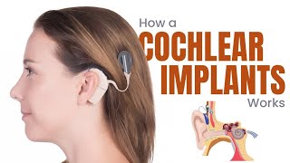 Cochlear Implants What are they and How do they work  3D Guide [upl. by Rodolfo]