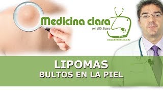 Bultos en la piel ¿sabes que es un lipoma ¿cómo eliminarlos ¿son peligrosos  Medicina Clara [upl. by Ezara205]