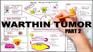 Warthin Tumor Salivay Gland Neoplasm  part 2 [upl. by Budge688]