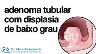 Adenoma tubular com displasia de baixo grau O que é isso [upl. by Dlabihcra]