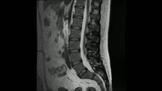 MR undersøkelse av normal korsrygg Normal lumbal columna [upl. by Annerb]