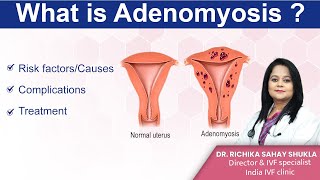 What is Adenomyosis Treatments Symptoms and Causes Dr Richika Sahay Shukla  India IVF Clinic [upl. by Faustena382]