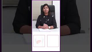 fibroid treatment without surgery bestfertilitycenter drarchanaivf fertility iui ivf [upl. by Dodwell]