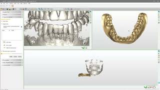 Match the intraoral scan to the CBCT scan step4 [upl. by Torin26]