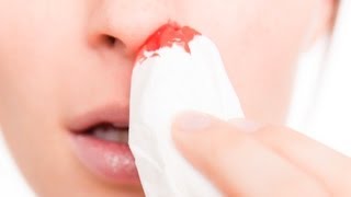 How to Treat a Nosebleed  First Aid Training [upl. by Ahsiket58]