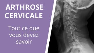 Tout ce que vous devez savoir sur larthrose cervicale  causes symptômes et traitements [upl. by Avrenim]