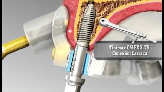 Guía quirúrgica en implantes dentales  Implantes NEODENT [upl. by Ahcsatan]