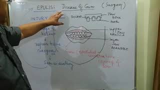 Surgery topic EPULIS part 1 [upl. by Ajim]