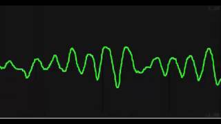 Ventricular Tachycardia Torsades De Pointes [upl. by Nara437]