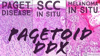 Pagetoid Differential Paget disease vs Melanoma in situ vs Squamous cell carcinoma in situ Bowen [upl. by Lynch530]