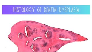 Histology of Dentin dysplasia  Dentistry [upl. by Nibaj431]