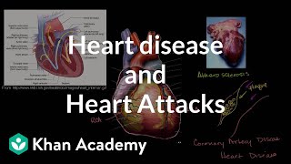 Heart disease and heart attacks  Miscellaneous  Heatlh amp Medicine  Khan Academy [upl. by Sukramaj]