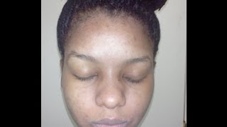 How kojic acid soap changed my face week 4 before and after pictures [upl. by Dunseath]