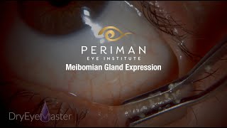 Meibomian Gland Expression [upl. by Adilen]