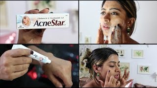 Acnestar Gel Review  HOW TO REALLY GET RID OF ACNE  SuperWowStyle Prachi [upl. by Sundin]