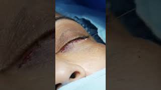 Blepharoplasty Complete Surgery with before amp After Results [upl. by Airotciv182]