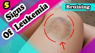 7 Signs and Symptoms You May Have a Leukemia [upl. by Venable259]