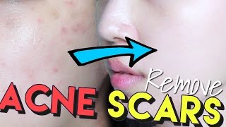 How To Get Rid of Acne Scars amp Hyperpigmentation • Get Brighter Skin [upl. by Suhpesoj]