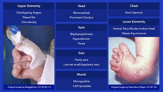 Trisomy 18 Edward Syndrome Dysmorphic Features [upl. by Suoiluj]