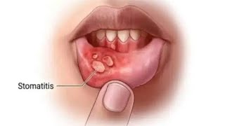 Stomatitis medicalstudent [upl. by Nelloc]