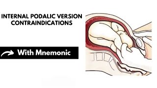 Internal Podalic Version Contraindications With Mnemonic  Obstetrics Mnemonics  Dr Mubashar Ata [upl. by Hoffarth]