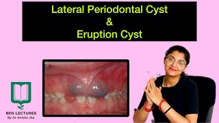 Lateral Periodontal Cyst  Eruption Cyst  Lecture 11  Cysts of Orofacial Region  ORAL PATHOLOGY [upl. by Hukill464]