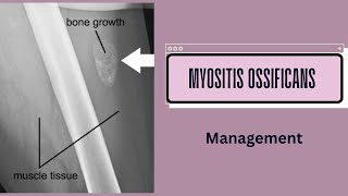 Management of Myositis Ossificans [upl. by Yrdua]