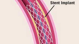 Angioplasty [upl. by Miah]