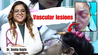 Alma IPL Laser is Best for Vascular Lesions संवहनी घावों के लिए उपचार क्या है [upl. by Ennoved]