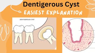 Dentigerous Cyst  Eruption Cyst  Learn in 5 minutes  Oral Pathology  BDS 3rd year [upl. by Susejedairam]