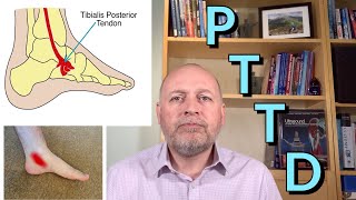 Posterior Tibial Tendon Dysfunction PTTD The best self help treatments [upl. by Trinity]