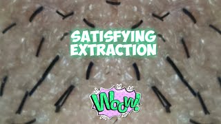 Satisfying Thick Hair Extraction  Hair Ingrown [upl. by Adnocahs868]