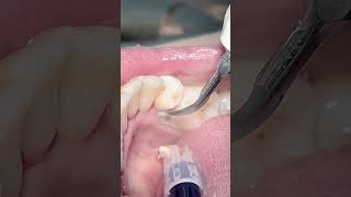 Scaling teeth tartar amp calculus dentist dental satisfying [upl. by Elodia977]