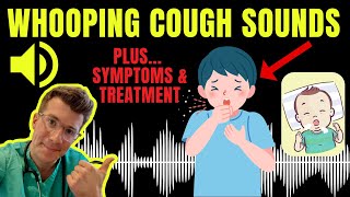 Doctor explains WHOOPING COUGH plus examples of REAL SOUNDS  Symptoms diagnosis treatment amp more [upl. by Hattie]