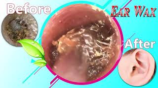 Ear Wax Removal Myths Debunked What You Need to Know 045 [upl. by Enert]