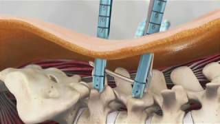 Palisade™ Pedicular Fixation System Animation [upl. by Ayt]