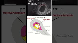 Ultrasound I Early pregnancy I double decidual sac sign DDSS [upl. by Anma875]