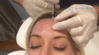 Botox Forehead Injection Treatment [upl. by Uahsoj]