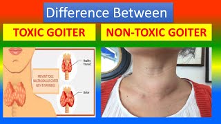 Difference Between Toxic Goiter and Nontoxic Goiter [upl. by Lemmie]