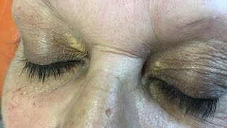 Xanthelasma dépots autour des yeux [upl. by Ecahc639]