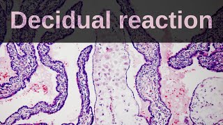 What is Decidual Reaction Pathology mini tutorial [upl. by Donahue]