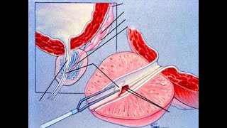 Ejaculatory Duct Obstruction  Symptoms amp Risk Factors [upl. by Ranson]