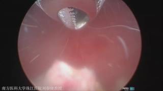 Minimally Invasive Surgery  Morcellator Surgery Video Prof ChunXiao Liu [upl. by Aneelahs]