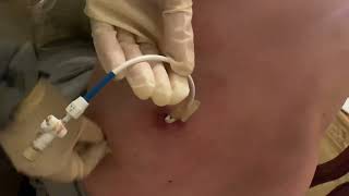 How to clean the area of nephrostomy or nephroureteral drain by Kathy [upl. by Duffie572]